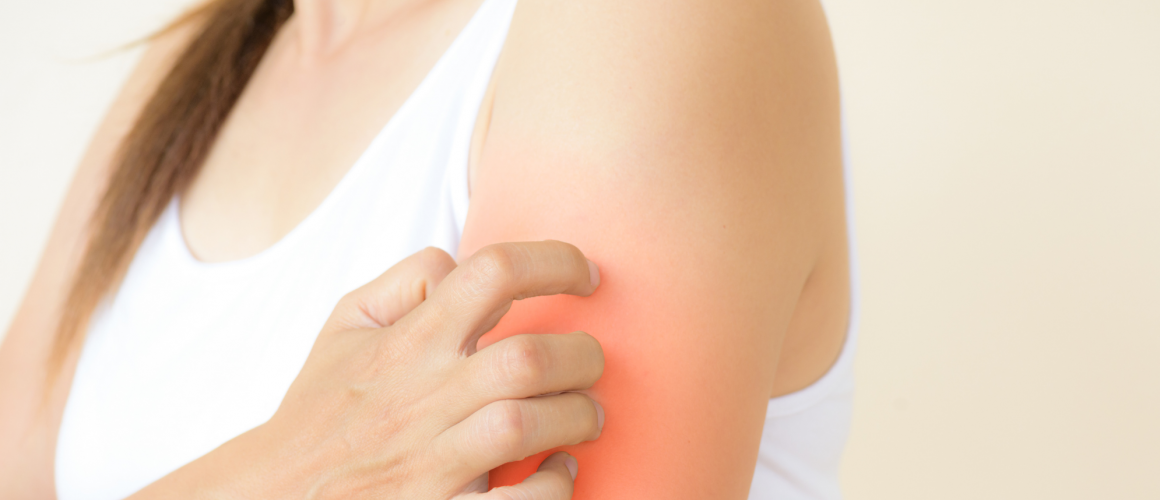 Dermatitis herpetiformis Duhring Frau kratzt sich aufgrund einer juckender Hautstelle am linken Oberärmchen